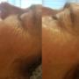 Resultaat na 1x HydroPeptide behandeling