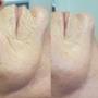 Resultaat na 1x HydroPeptide behandeling
