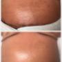 Resultaat na 1x HydroPeptide behandeling