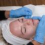 Acne behandeling