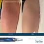 Striae behandeling microneedling