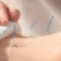 Acupunctuur Eindhoven & Best