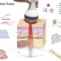 Lasertherapie apeldoorn