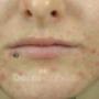 Chemische peeling | Huidtherapie Huizen
Wat is chemische peeling?
Een chemische/medische peeling is een peeling die wordt toegepast met zuren. Er worden verschillende zuren gebruikt die elk een andere functie hebben. Tevens verschillen deze zuren van zuurgraad (pH waarde) en penetratiediepte in de huid. Onze peelings zijn van Dermaquest en Lira en kunnen glycolzuur, melkzuur, salicylzuur of trichloorazijnzuur (TCA) bevatten. Deze peelings worden veelal gecombineerd toegepast. We maken onderscheid in milde of diepe peelings, waarbij we altijd beginnen met een milde peeling en toe werken naar een steeds diepere peeling. Chemische/medische peelings worden ingezet bij het behandelen van verschillende huidaandoeningen waaronder: huidveroudering, huidverslapping, acne, (acne)littekens, pigmentvlekken, grove poriën, rosacea, couperose en zonbeschadiging.