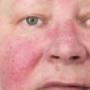 Coagulatietherapie | Huidtherapie Huizen

Wat is coagulatietherapie?

Coagulatietherapie is het verwijderen van een gesprongen vaatje, fibromen (steelwratten), een goedaardige moedervlek of andere huidoneffenheden. Er zijn verschillende behandelmethodes beschikbaar en bij het intakegesprek kijken we naar welke behandeling het beste bij je past.
Veelal zijn we met 1 behandeling klaar en laat het geen littekens achter.