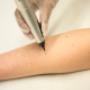 Behandeling Cryotherapie