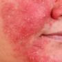 behandeling-rosacea