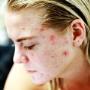 blog-acne-oorzaken-en-behandeling