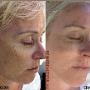 voor-en-na-dermapen-behandeling